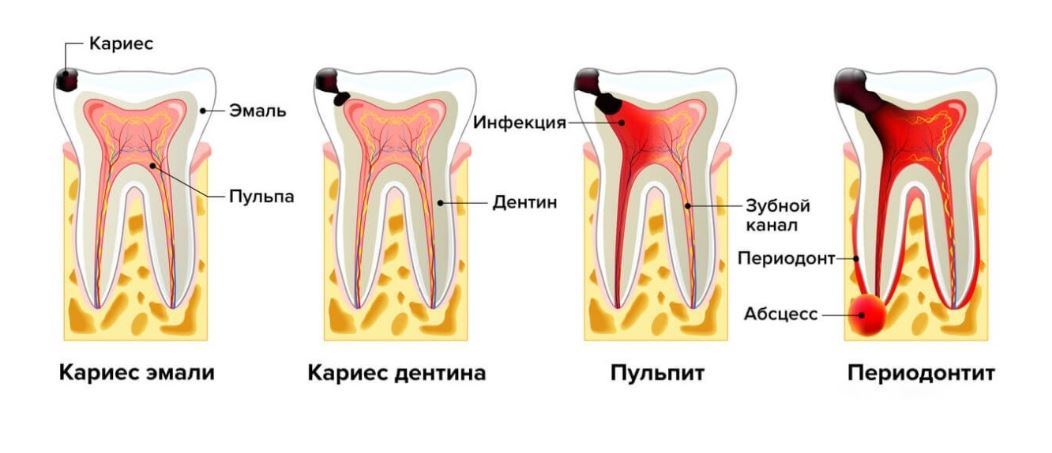 Что такое кариес
