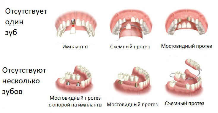 Какие бывают зубные протезы