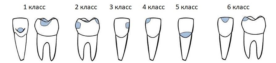 Види та класифікація карієсу