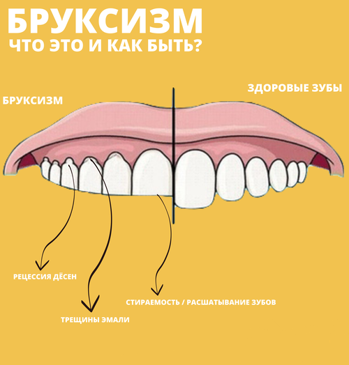 Що таке бруксизм?